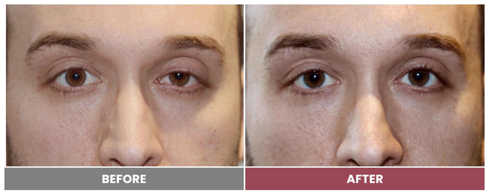 PTOSIS REPAIR - Case 49